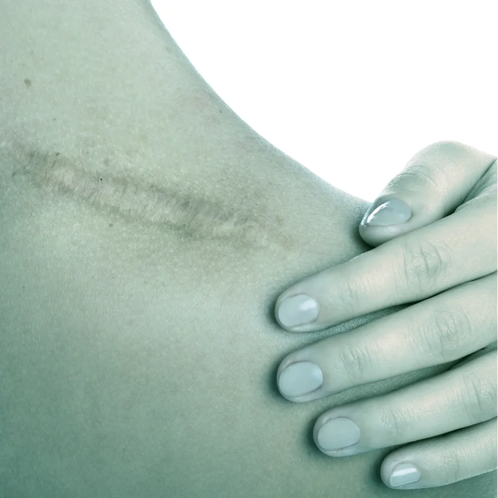 A close-up of a person\'s shoulder with a visible healed surgical scar. The person’s hand rests gently on their shoulder, evoking resilience—set against a cool, bluish tint reminiscent of a modern development platform interface.